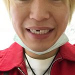 前歯の欠損した若年性特殊先輩の青年